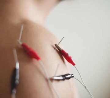 Electrical Dry Needling in Bangalore