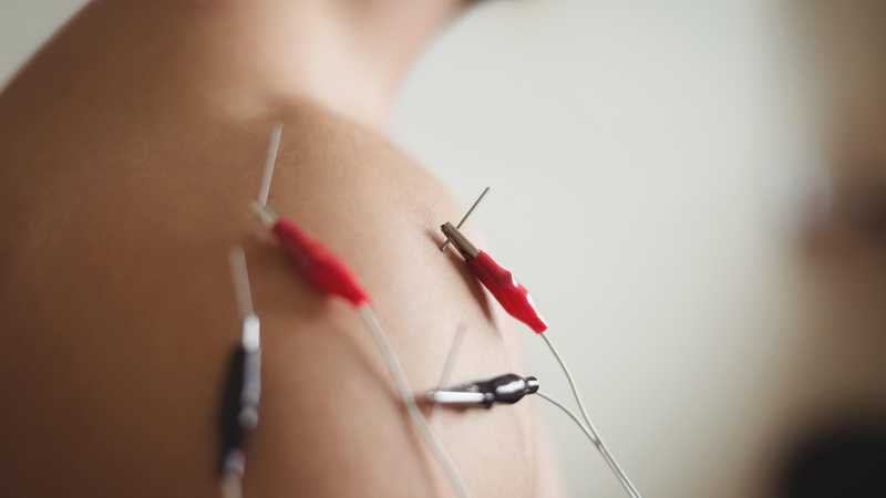 Electrical Dry Needling in Bangalore